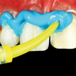 Additional Silicone Putty